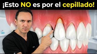Her gums did NOT recede because of brushing. The reason will surprise you.
