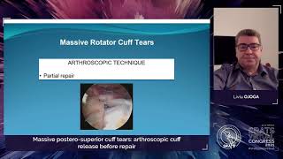 Extra-articular shoulder arthroscopy