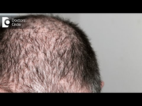 Minoxidil Tablets I.P. 5 mg