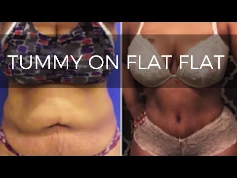 Tummy Tuck and Brazilian Butt Lift For Sexy Curves