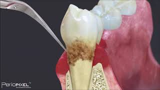 RASPADO Y ALISADO RADICULAR. (Teoría y simulación).