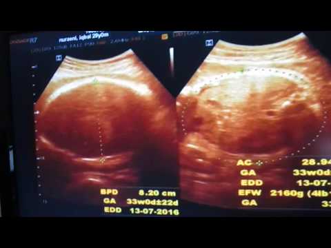 Melompat pelangsing paling efektif Jika Anda memperlakukan tiroid dapat menurunkan berat badan