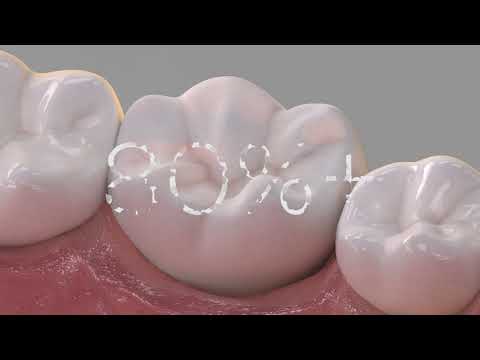 Enhance - Intro I Dentsply Sirona