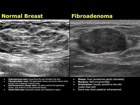 Brustultraschall: Normalbefund vs. Fibroadenom | Ultraschalluntersuchung gutartiger Brustknoten/T...
