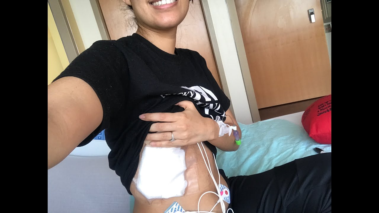 My Endometriosis Journey | Diaphragmatic Endometriosis