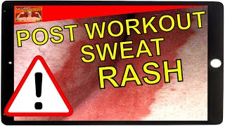 How To Treat Sweat Rash