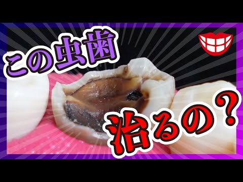 両歯歯症について詳しく解説