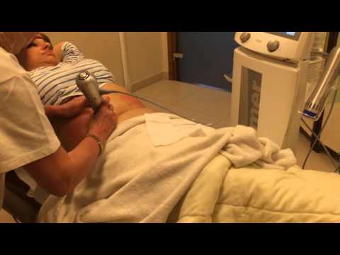 Terapia falą uderzeniową ZWavePro po zabiegu kriolipolizy ZLipo