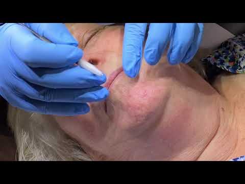 Red vein removal