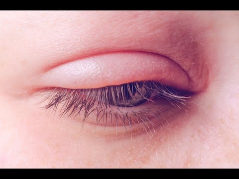 Si të largojmë fryrjen e syve?