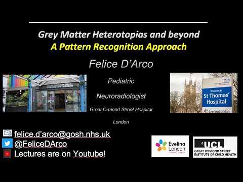 Grey Matter Heterotopia: Pattern recognition approach !!