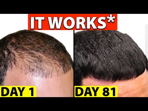 Finalo 1 Mg Tablet, For Hair Growth