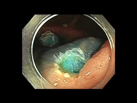 Colonoscopy: IC Valve Flat Lesion Resection