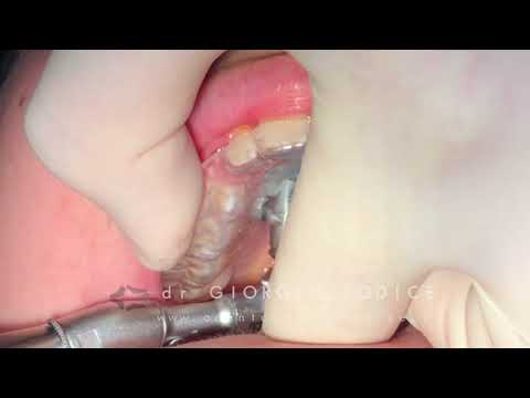 [Dr Giorgio Iodice] Dima per inserimento guidato OrthoEasy Pal / Frog