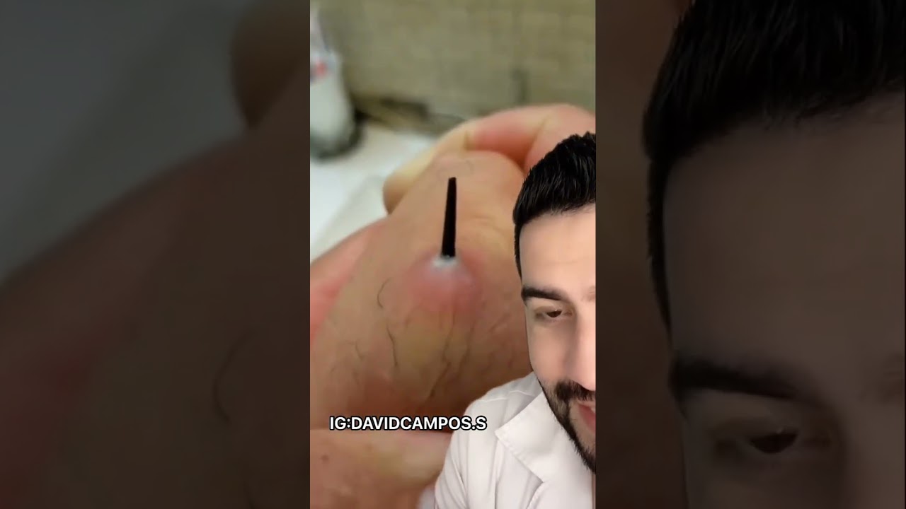 ESPINA DE MAS DE 13 AÑOS EN SU CUERPO