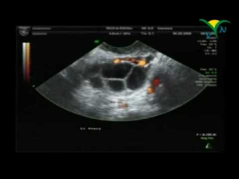 Osteocondrosi della colonna fisioterapia cervicale-toracica Displasia dellanca negli adulti