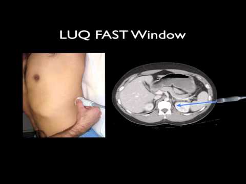 Ultrasound Troubleshoot LUQ, Spleen