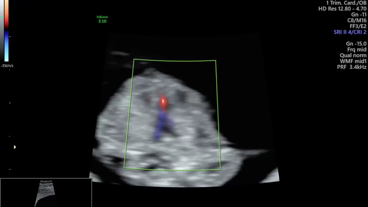 CRUZAMENTO DE GRANDES VAZOS CARDIACOS
