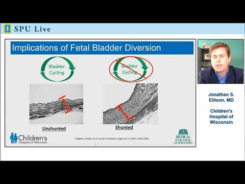 SPU Live: What is the Best Postnatal Surgical Intervention for Posterior Urethral Valves?