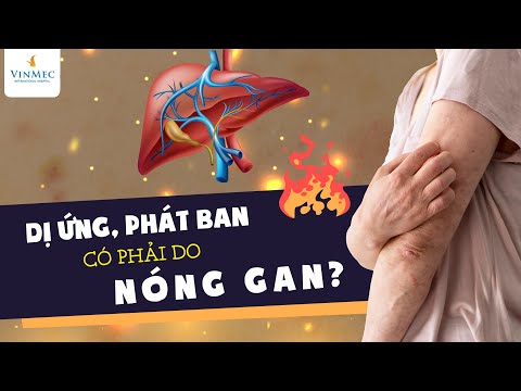 , title : 'Dị ứng, phát ban có phải do nóng gan?| BS Nguyễn Duy Bộ, BV Vinmec Times City'
