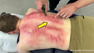 UNREAL...Heat Rises From His Back - Nerves On Fire From SCOLIOSIS - CRACKS & DEEP TISSUE HELP!