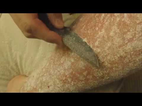 Come esorcizzare leczema Con eczema non telefonano