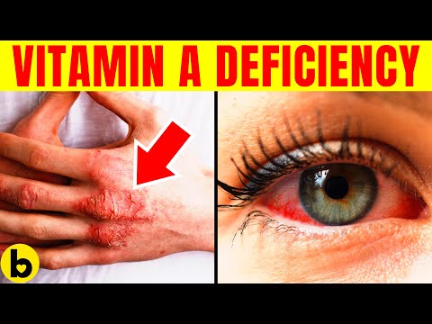 9 Sneaky Symptoms That Can Be A Sign of a Vitamin A Deficiency