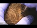 Scalp Micropigmentation Makes Hair Look Thicker Insider Beauty