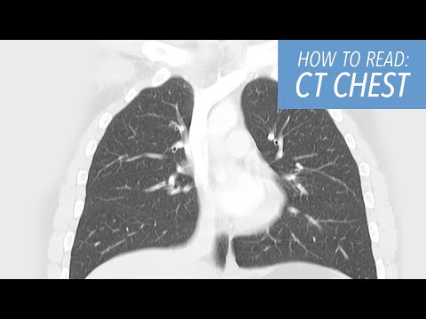 How to Read a CT of the Chest: Basic Search Pattern for Beginners
