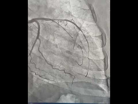 LAD-D1 bifurcation using MINI CRUSH technique