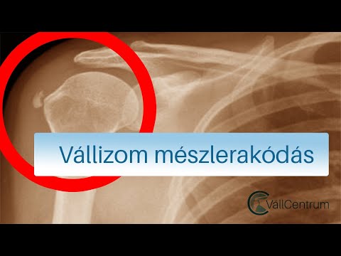 kenőcs a váll ízületeinek fájdalmára ízületek a csípőben járás közben