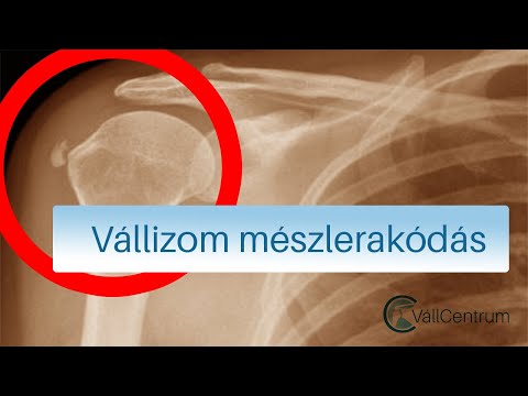 Nyaki osteochondrozis kenőcs