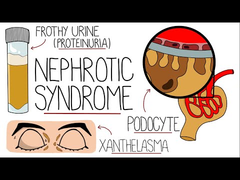 Le syndrome néphrotique expliqué clairement