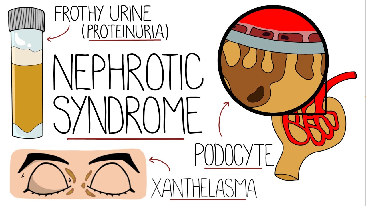 Nephrotic Syndrome Explained Clearly