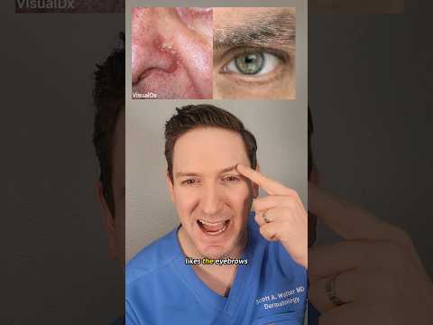 A dermatologist explains Seborrheic Dermatitis: What is it?How to treat?#seborrheicdermatitis #derm