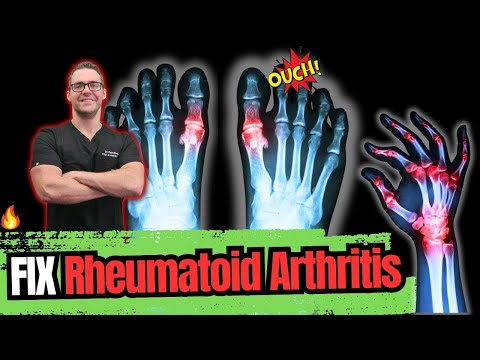 Rheumatoid Arthritis [Symptoms, Early Signs, Stages & BEST Treatment]