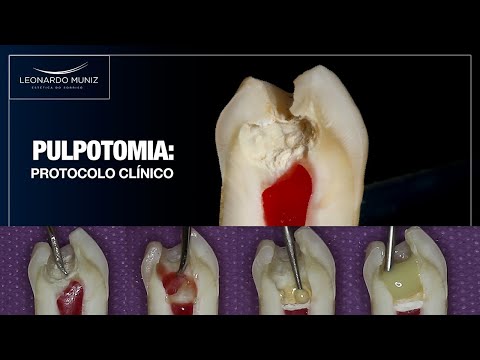 Leonardo Muniz "Pulpotomia: Protocolo Clínico"