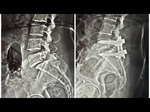 Lumbar Spondylolisthesis? - Dr. Ajay Kothari