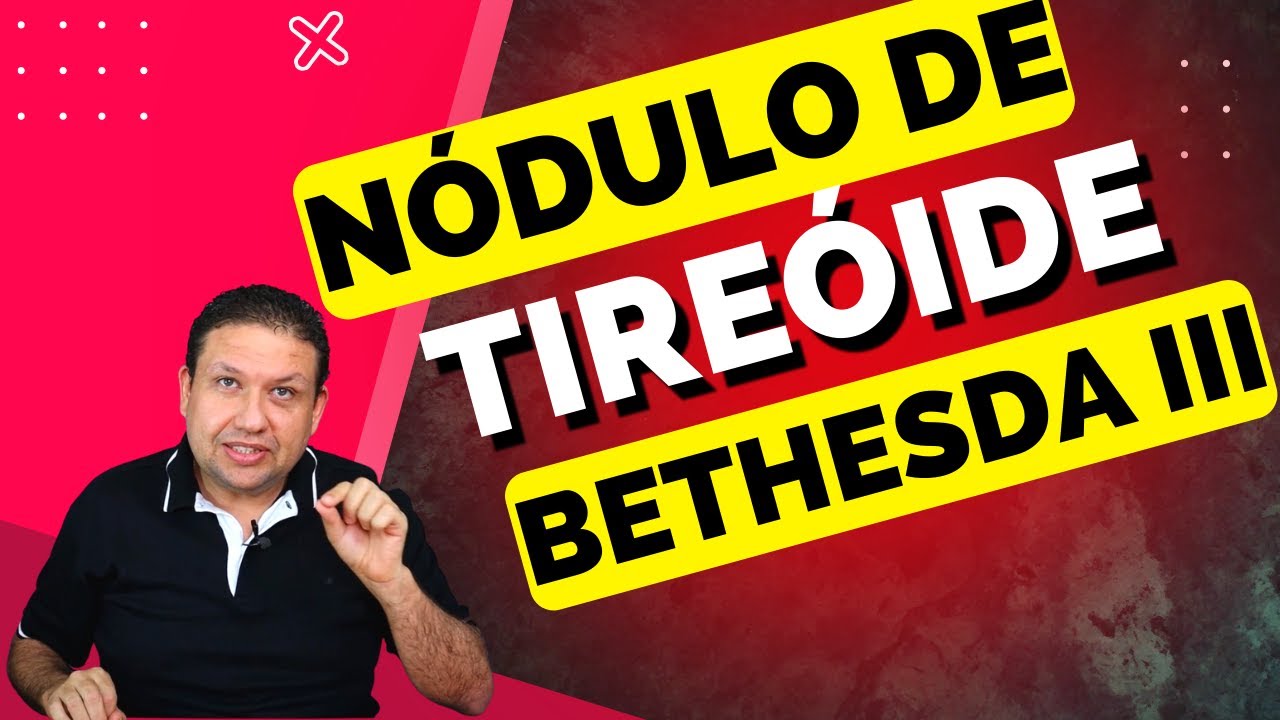 NÓDULO DE TIREÓIDE INDETERMINADO, BETHESDA 3, NÓDULO DE TIREÓIDE TIPO III.