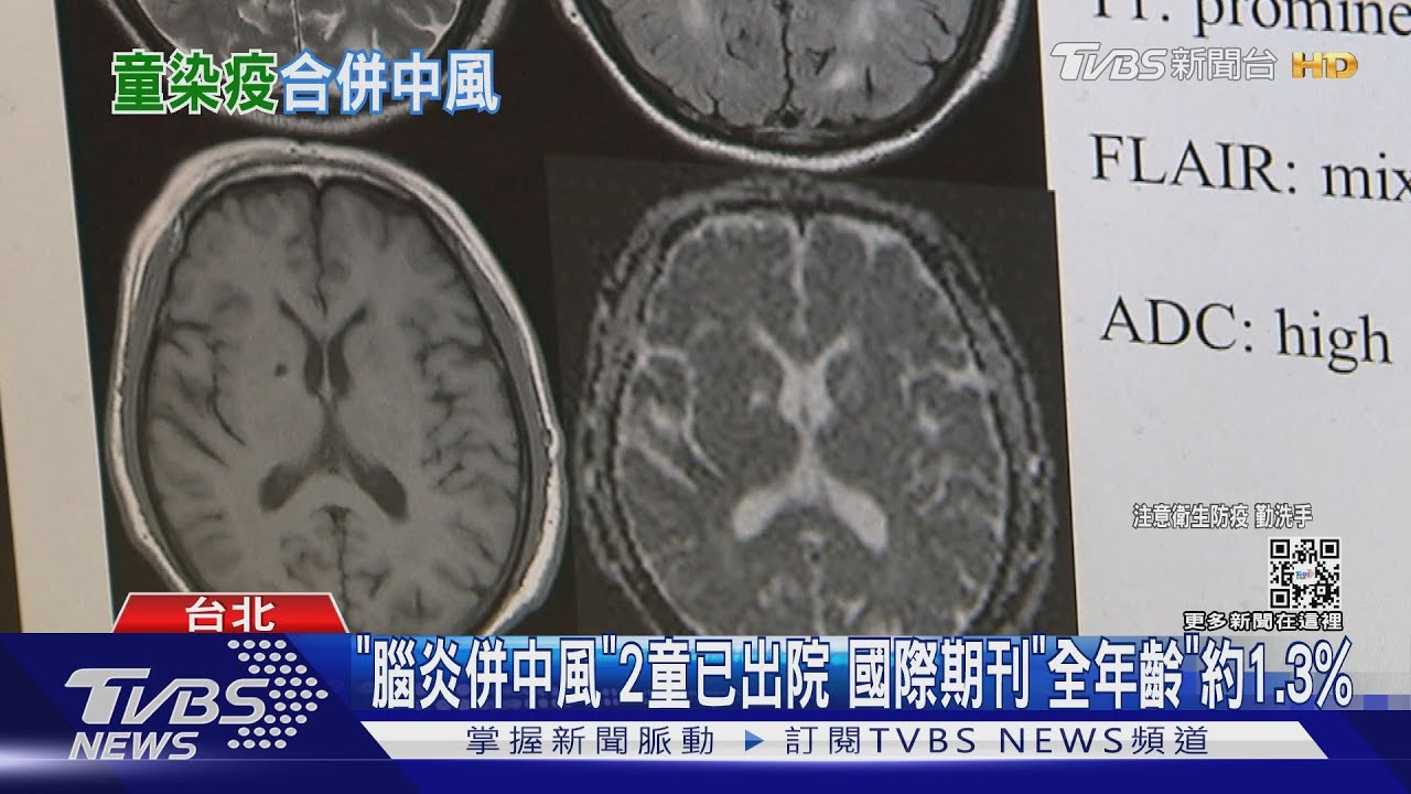 台大研究「兒童染新冠」 1163人中2例腦炎併中風
