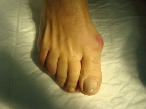 comment guerir un oignon au pied