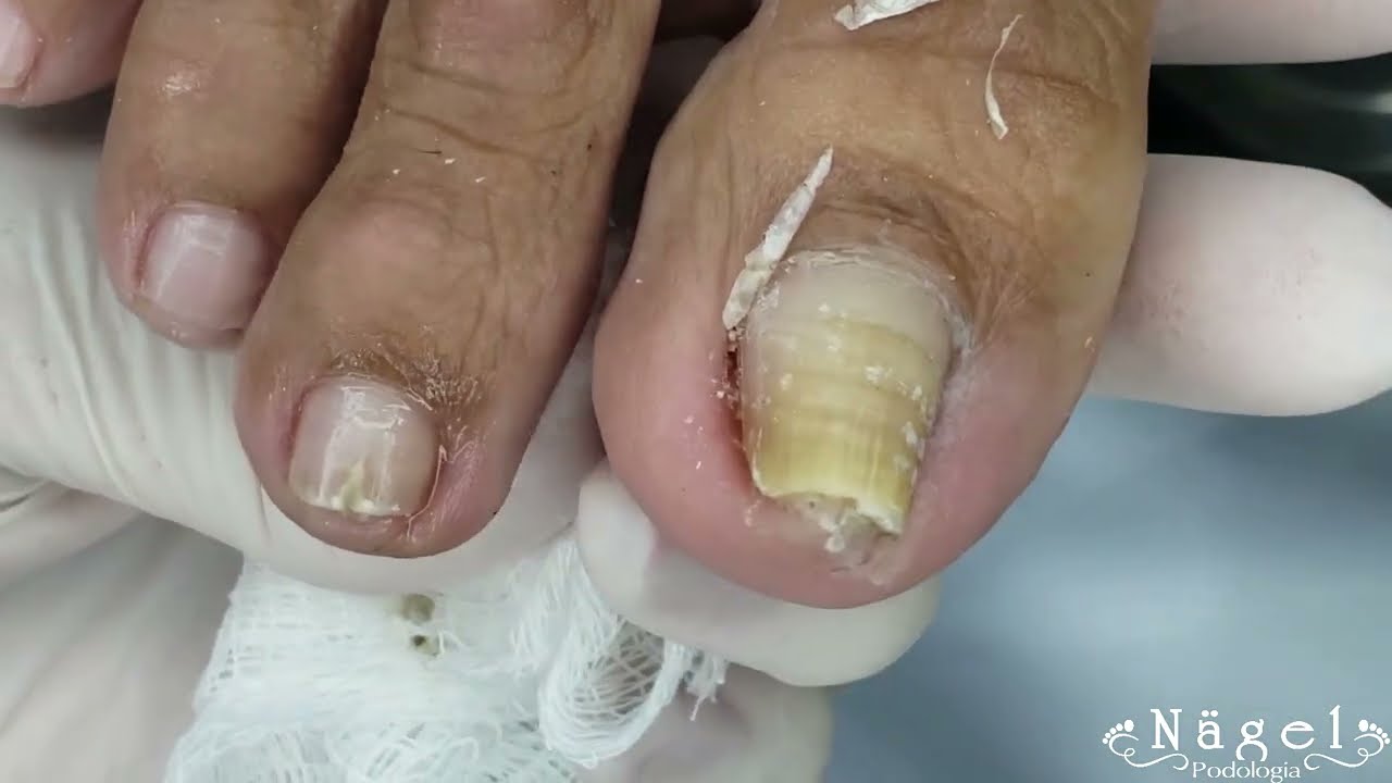 A UNHA MAIS ENCURVADA QUE JÁ PEGUEI