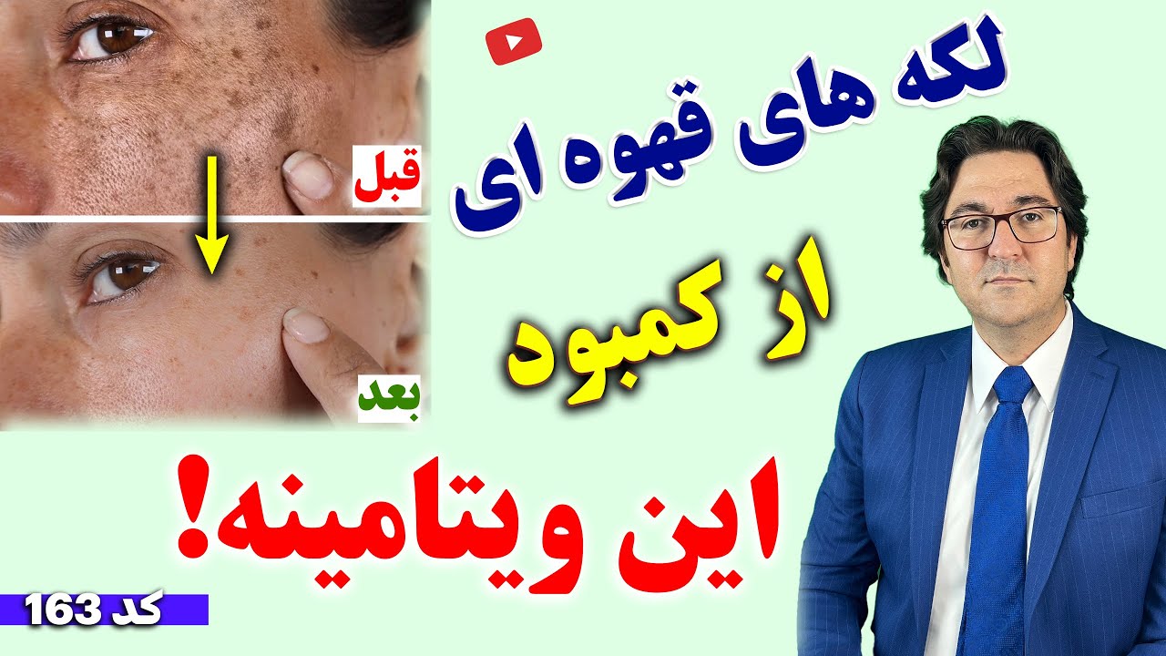 درمان تضمینی لکه‌ های قهوه ای و لکه های پیری پوست دست و صورت بدون دارو و لیزر با این روش معجزه آسا!