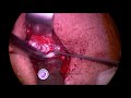 Preserving Non Recurrent Laryngeal Nerve ( anatomical variation ) in VNS Surgery - Sait OZTURK, MD