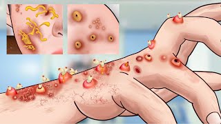 ASMR Removing Pimples on Hands & Cystic Acne on Body | Pimple Squeezing Animation