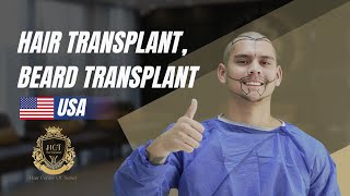 Marcos GARCIA Hair Transplant, Beard Transplant - (Transplante Capılar) - #transplantecapilar