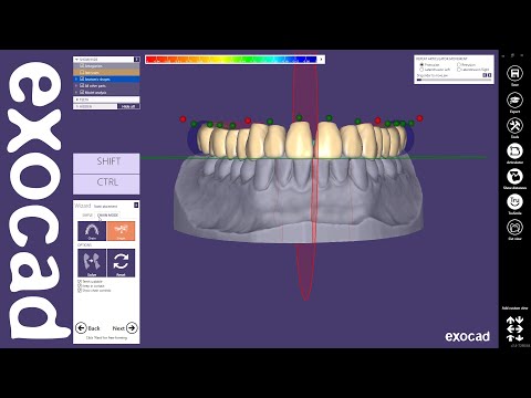 Tutorial: Designing a single arch denture