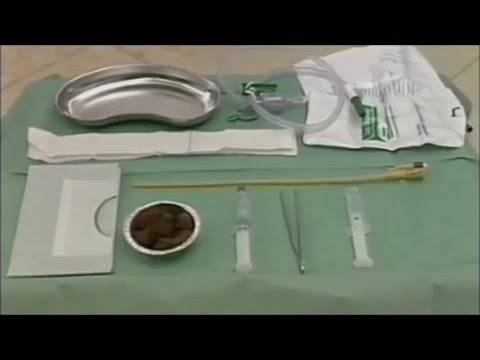 Della prostata negli uomini a San Pietroburgo Nodo nella prostata è