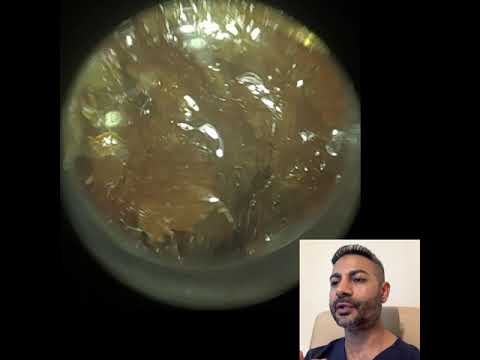 436 - 100% Blocked Ear Wax Removal Using the New WAXscope® Specula