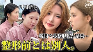 鼻整形だけで別人級…韓国での変化がすごすぎる。| AB美容整形